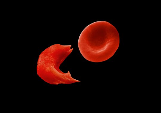 SICKLE CELL CRISES: Understanding what it is all about and Identifying Possible Trigger Factors.